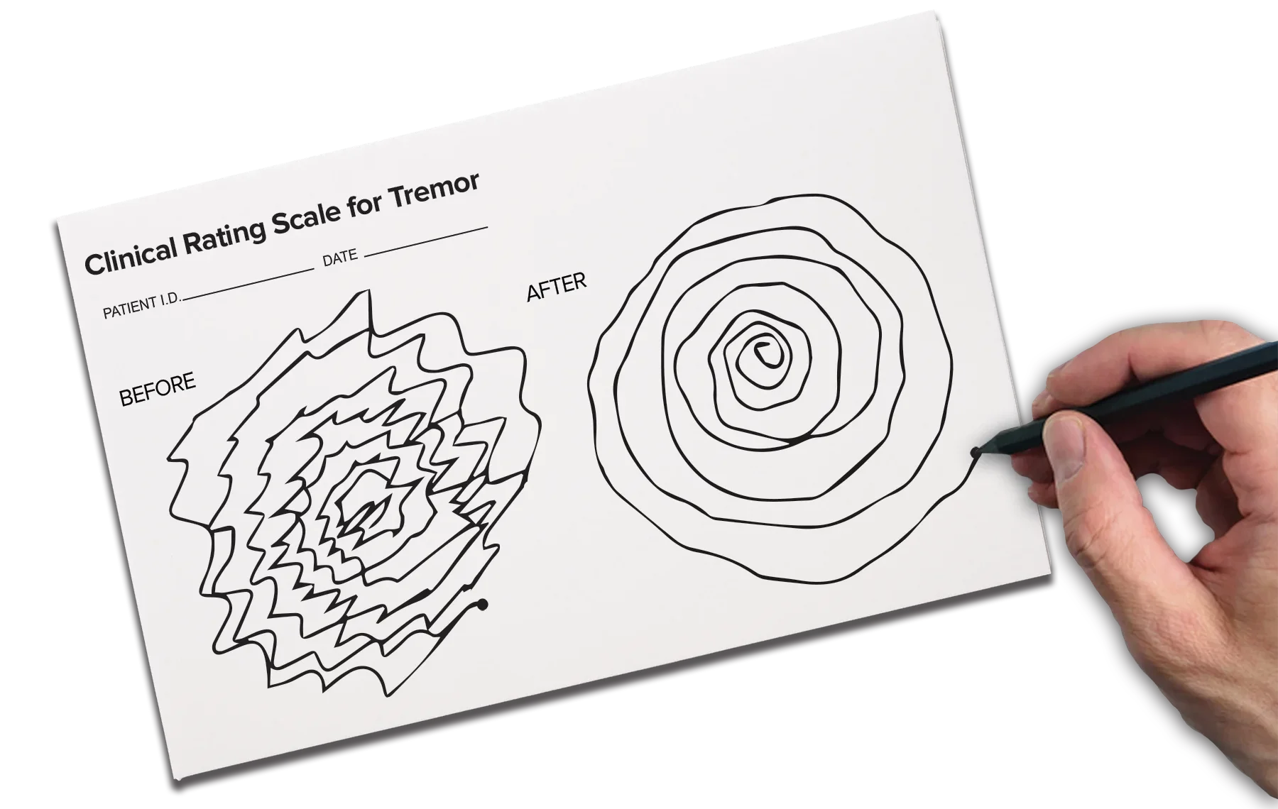 A hand drawing the Archimedes spiral on a Clinical Rating Scale for Tremor form, showing a jagged &ldquo;before&rdquo; spiral beside a smooth &ldquo;after&rdquo; spiral